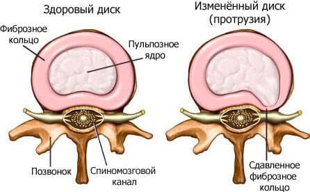 зображення здорового міжхребцевого диску та зміненого внаслідок протрузії