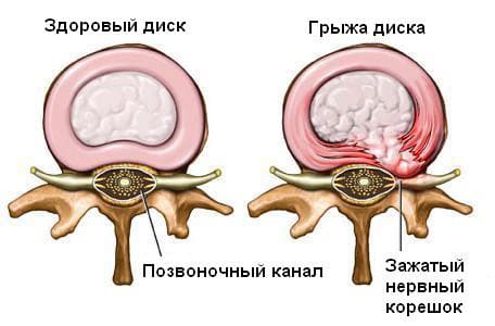 зображення здорового міжхребцевого диску та зміненого внаслідок грижі